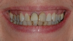 BEFORE -Discoloured Teeth restored with Smile Makeover - Dr. Stewart Hum
