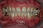 BEFORE - Unesthetic Upper Teeth - Prosthodontics on Chamberlain 