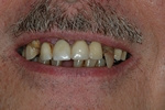 BEFORE - Failing Upper/Lower Teeth - Prosthodontics on Chamberlain