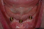 BEFORE - 3 Lower Implants (LOCATORS) - Ottawa Prosthodontist 