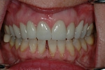 AFTER -Upper Teeth Restored - Ceramic Veneers - Prosthodontics on Chamberlain - Ottawa Implants