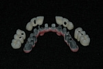 AFTER - The Metal Bridge with cemented Crowns - Dental Implants Bridge - Prosthodontics on Chamberlain - Ottawa Implants