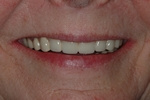 AFTER - Final smile with full mouth Dental Implant Bridges