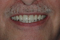 AFTER -Full Denture following removal of all teeth -Prosthodontics on Chamberlain, Ottawa